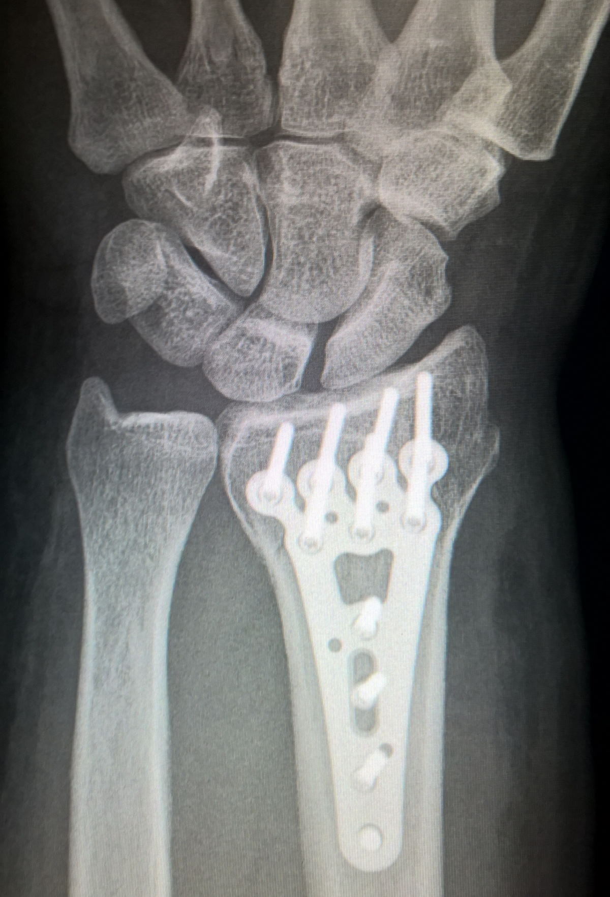 Снимок трещины. Титановая пластина на рентгене. Трещина лучевой кости рентген. Рентгенограмма перелом кости.